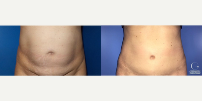 Case 352 - Woman treated with Tummy Tuck