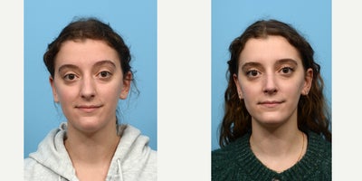 Case 3525 - 18-24 year old woman treated with Rhinoplasty