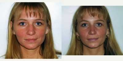 Case 3534 - 35-44 year old woman treated with Rhinoplasty