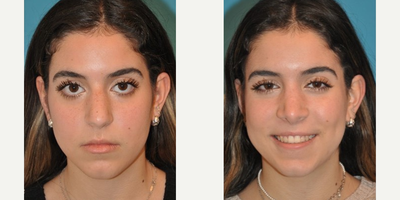 Case 3535 - Woman treated with Rhinoplasty