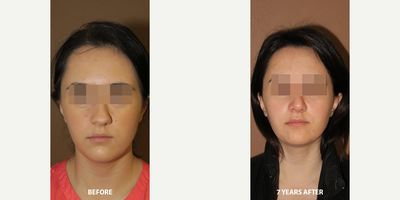 Case 3540 - Woman treated with Rhinoplasty