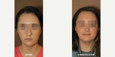 Case 3541 - Woman treated with Rhinoplasty