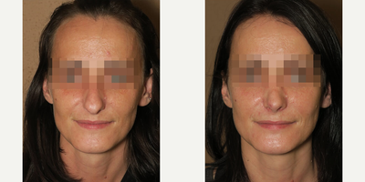 Case 3542 - Woman treated with Rhinoplasty