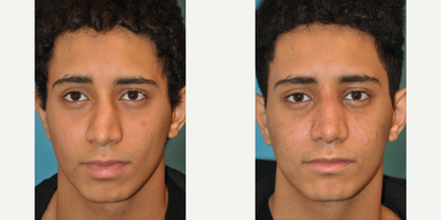Case 3543 - Man treated with Rhinoplasty