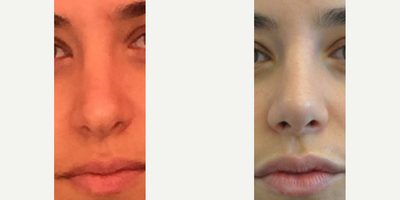 Case 3544 - Woman treated with Rhinoplasty