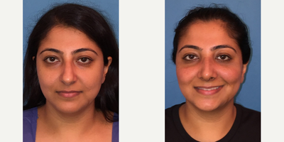 Case 3545 - Woman treated with Rhinoplasty