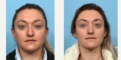 Case 3548 - 25-34 year old woman treated with Rhinoplasty