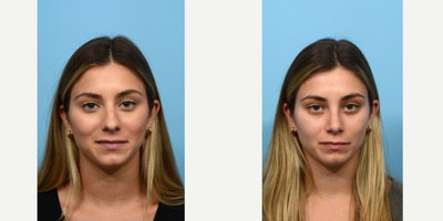 Case 3549 - 25-34 year old woman treated with Rhinoplasty