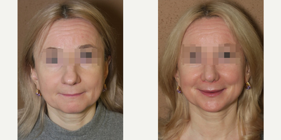 Case 3550 - Woman treated with Rhinoplasty