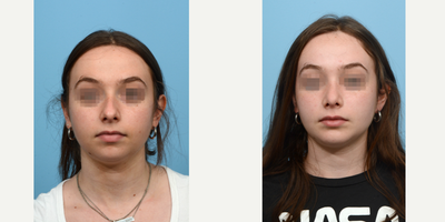 Case 3554 - 18-24 year old woman treated with Rhinoplasty