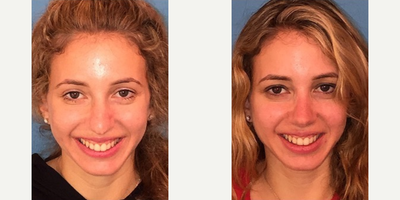 Case 3555 - Woman treated with Rhinoplasty