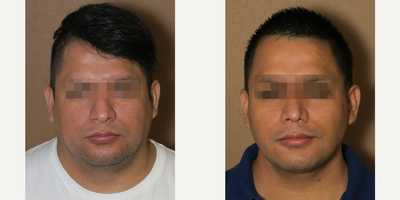 Case 3556 - Man treated with Rhinoplasty