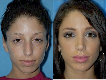 Case 3557 - Rhinoplasty