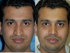 Case 3558 - Rhinoplasty