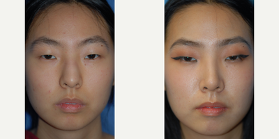 Case 3559 - Rhinoplasty