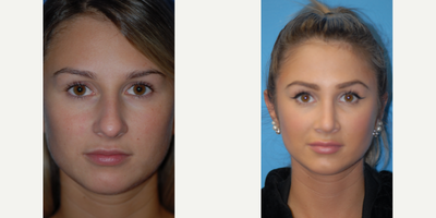 Case 3560 - Rhinoplasty