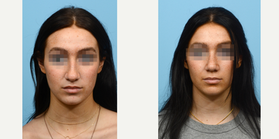 Case 3561 - 17 or under year old man treated with Rhinoplasty