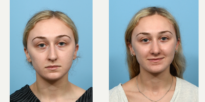 Case 3567 - 18-24 year old woman treated with Rhinoplasty