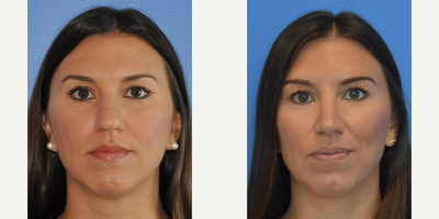 Case 3580 - 35-44 year old woman treated with Rhinoplasty