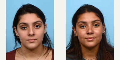 Case 3581 - 18-24 year old woman treated with Rhinoplasty