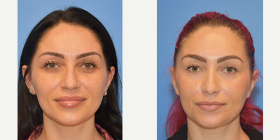 Case 3582 - 35-44 year old woman treated with Rhinoplasty