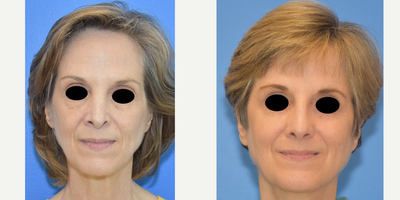Case 3583 - 55-64 year old woman treated with Rhinoplasty
