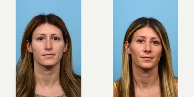 Case 3584 - 35-44 year old woman treated with Rhinoplasty