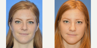 Case 3585 - 18-24 year old woman treated with Rhinoplasty