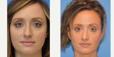 Case 3586 - 25-34 year old woman treated with Rhinoplasty
