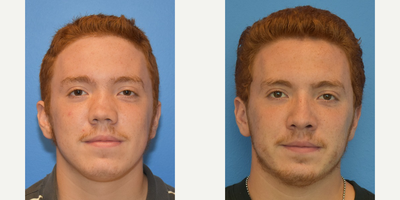 Case 3587 - 25-34 year old man treated with Rhinoplasty