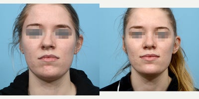 Case 3588 - 18-24 year old woman treated with Rhinoplasty