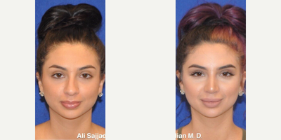 Case 3589 - Woman treated with Rhinoplasty