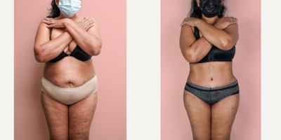 Case 359 - 55-64 year old woman treated with Tummy Tuck