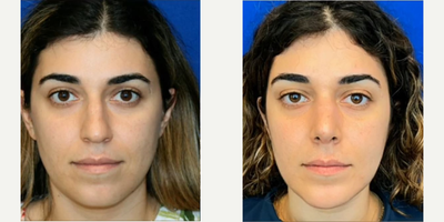 Case 3590 - Woman treated with Rhinoplasty