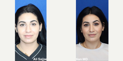Case 3591 - Woman treated with Rhinoplasty
