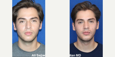 Case 3592 - Man treated with Rhinoplasty