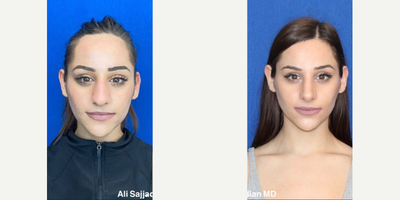 Case 3593 - Woman treated with Rhinoplasty