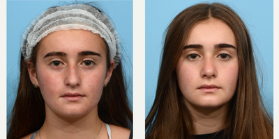 Case 3596 - 35-44 year old woman treated with Rhinoplasty