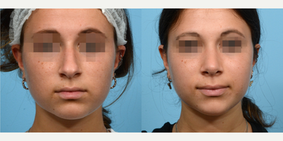 Case 3597 - 18-24 year old woman treated with Rhinoplasty