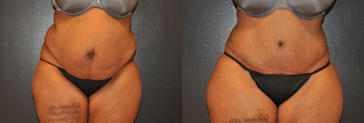Case 36 - Woman treated with Tummy Tuck