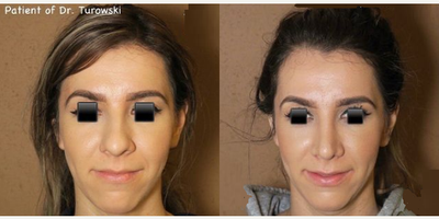 Case 3601 - Woman treated with Rhinoplasty