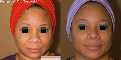 Case 3602 - Woman treated with Rhinoplasty