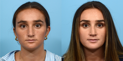 Case 3603 - 18-24 year old woman treated with Rhinoplasty