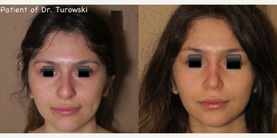 Case 3604 - Woman treated with Rhinoplasty