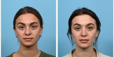 Case 3605 - 18-24 year old woman treated with Rhinoplasty