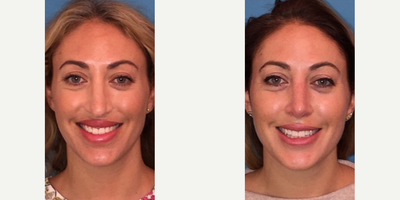 Case 3606 - Woman treated with Rhinoplasty