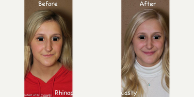 Case 3607 - Woman treated with Rhinoplasty