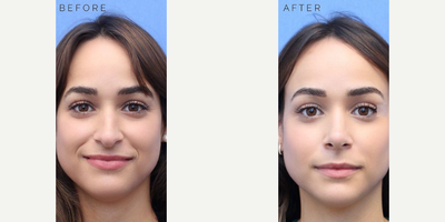 Case 3608 - Woman treated with Rhinoplasty