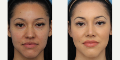 Case 3609 - Woman treated with Rhinoplasty