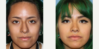 Case 3610 - Woman treated with Rhinoplasty